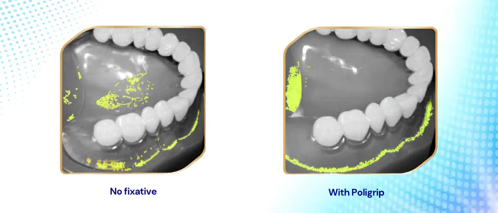 Food entrapment images with and without Poligrip fixative, showing that Poligrip helps to reduce food entrapment vs no fixative