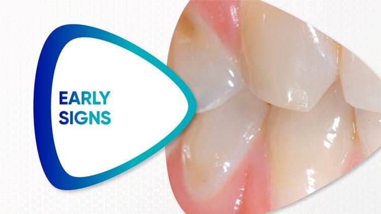 Text reads ‘early signs’ with an image of teeth with early signs of erosive tooth wear