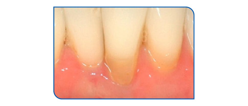 Image of sensitive teeth and gums