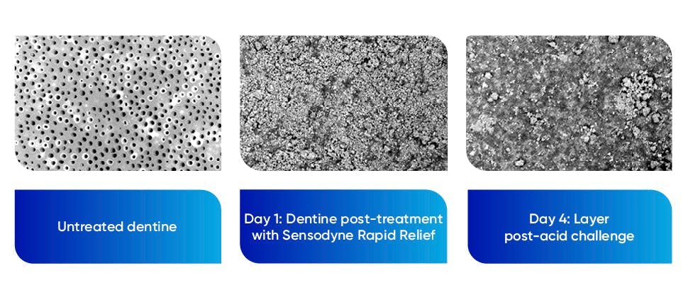 Close-up images of dentine before and after stannous fluoride application