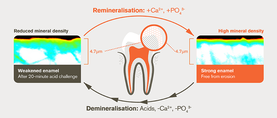 Demineralisation and remineralisation process after 20-minute acid challenge