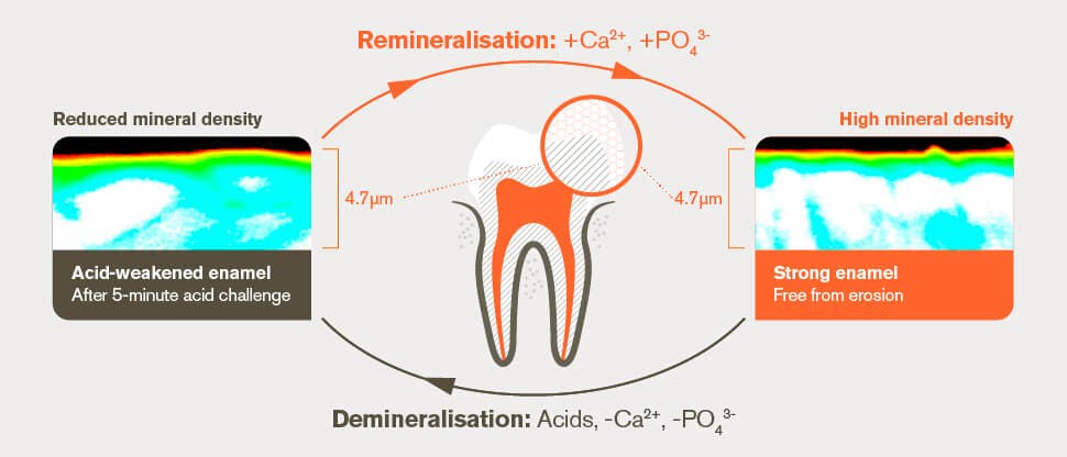 Remineralisation and demineralisation process after 5-minute acid challenge