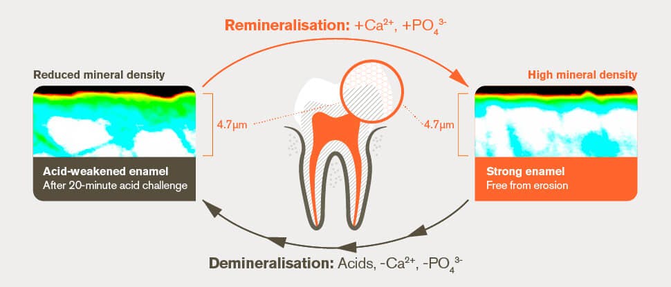 Remineralisation and demineralisation process after 20-minute acid challenge