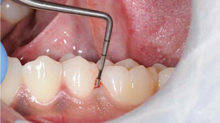 How To Diagnose Gum Inflammation Disease Corsodyl How To Diagnose Gum Inflammation Disease Corsodyl