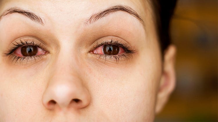 Allergies