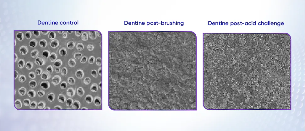 Scanning electron microscope (SEM) images of dentine surface showing dentine control, dentine surface post-brushing and dentine surface after acid challenge