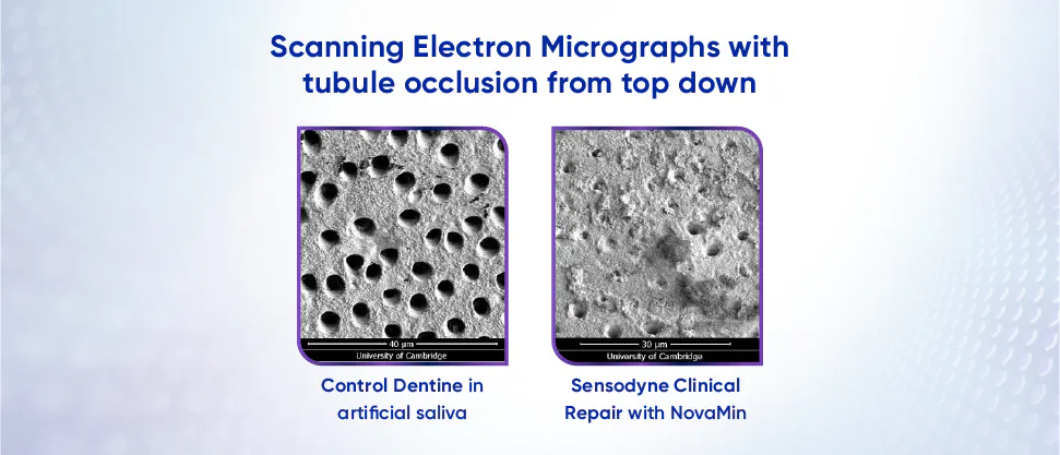 Image of dentine tubules after treatment with toothpaste