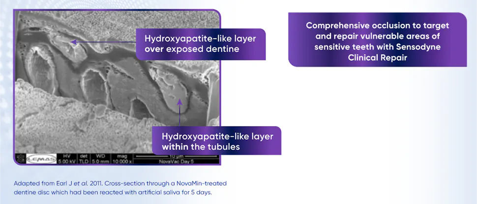 NovaMin forming a protective layer over exposed dentine