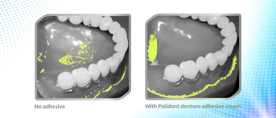 Food entrapment images with and without Polident adhesive