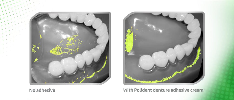 Food entrapment images with and without Polident adhesive