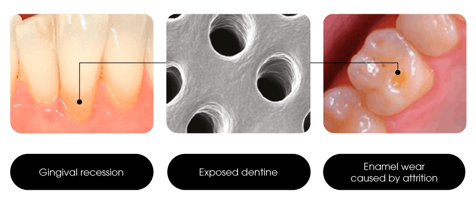 Causes of exposed dentine