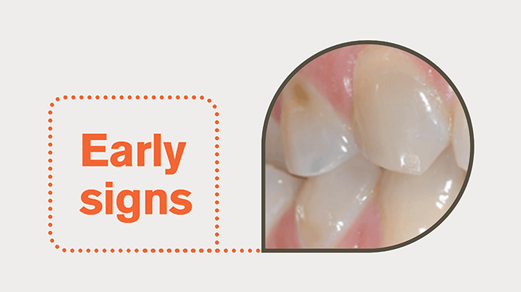 Early signs of enamel wear