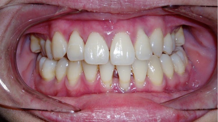 Aggressive periodontitis