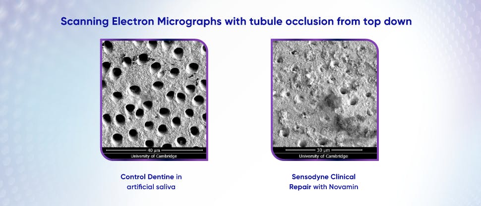 Image of dentine tubules after treatment with toothpaste