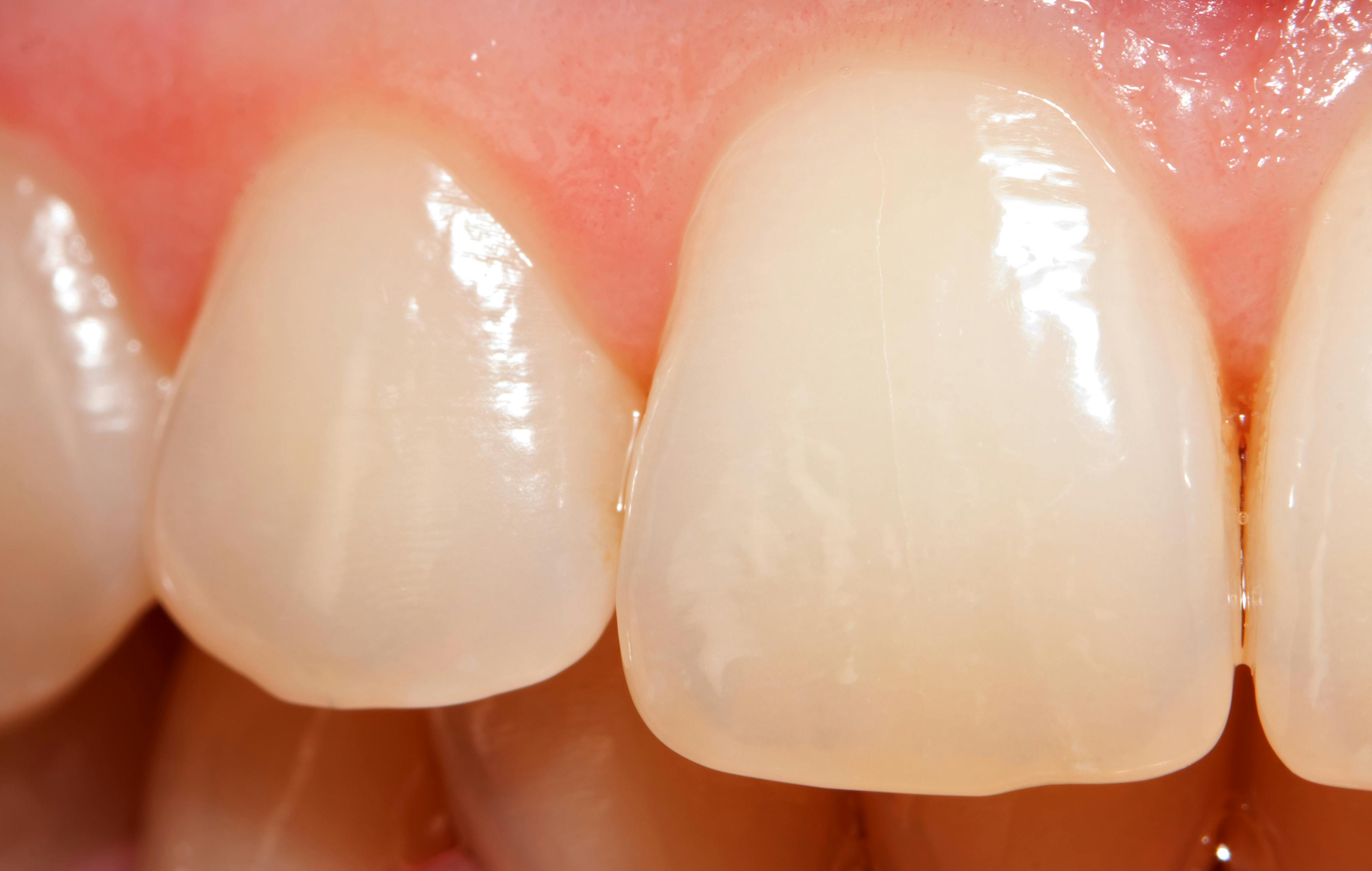 Enamel worn teeth