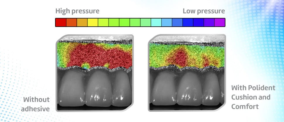 Pressure relieved on gums by using Polident adhesive
