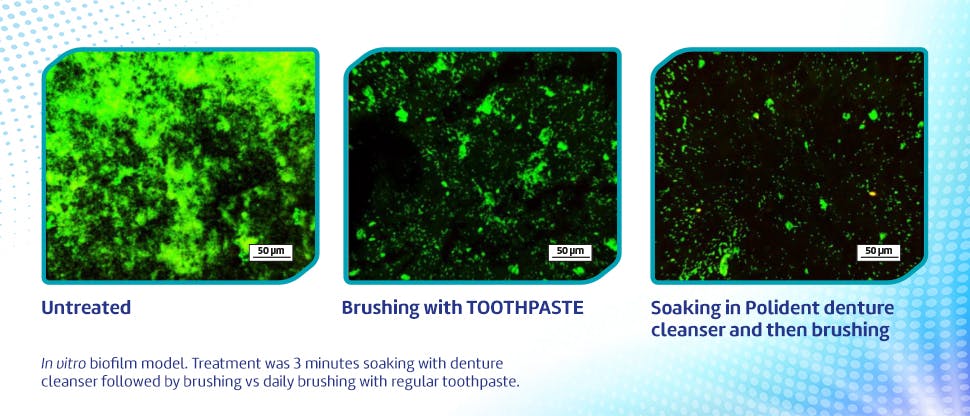 Images showing how more bacteria and yeast is removed by soaking appliance in Polident compared to brushing with toothpaste