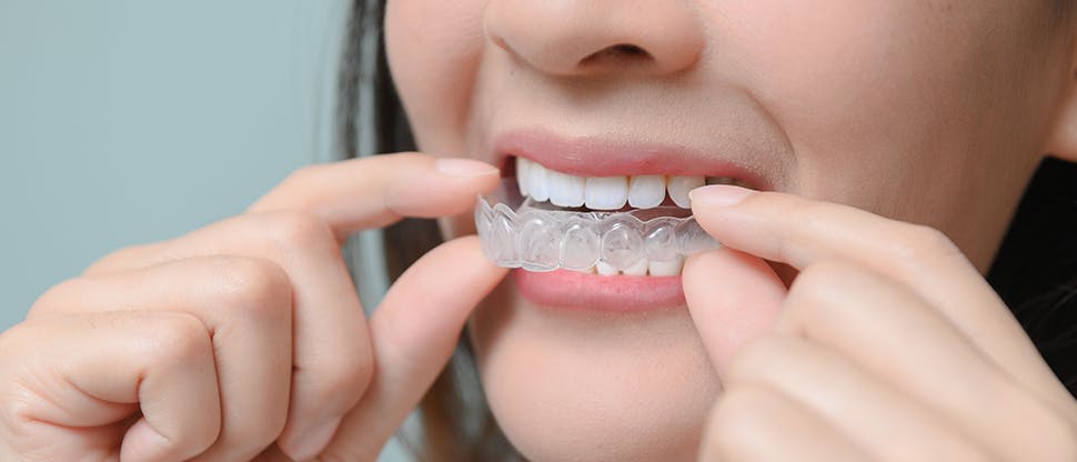 Woman inserts her removable retainer