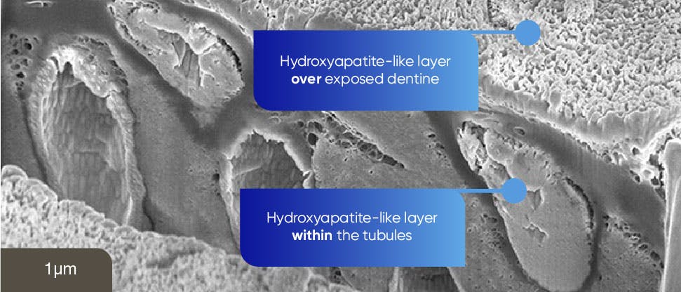 SEM image of hydroxyapatite-like layer over exposed dentine
