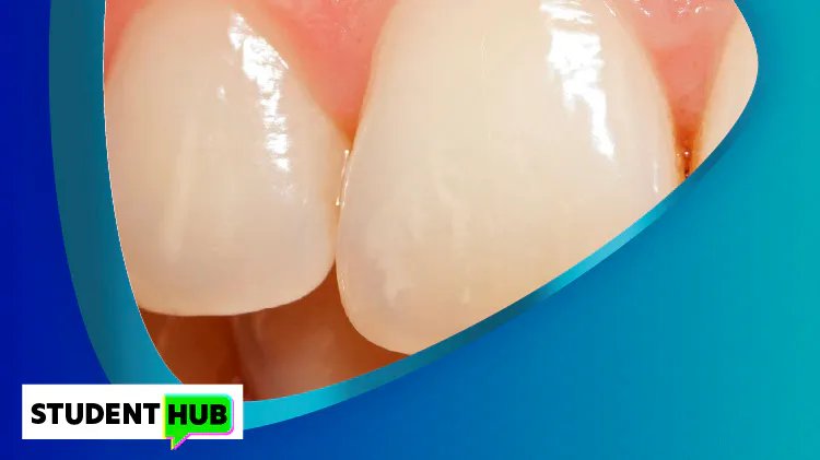 Tooth with enamel erosion