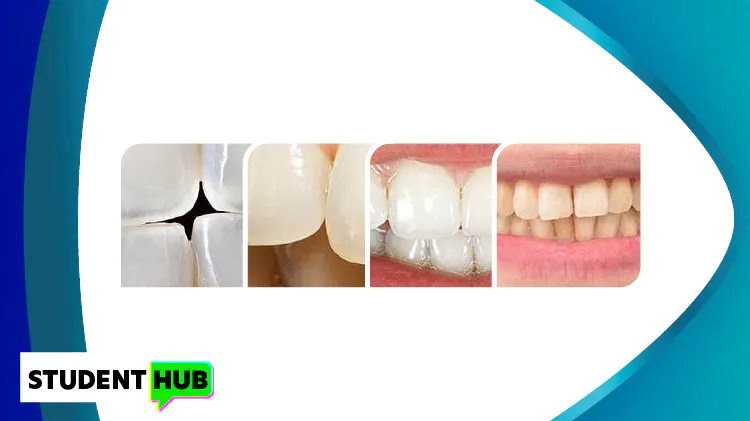 Range of teeth showing symptoms of enamel erosion