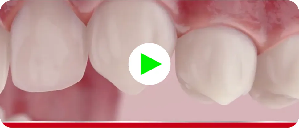 How Gingivitis Develops