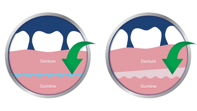 Xerostomia can limit denture retention
