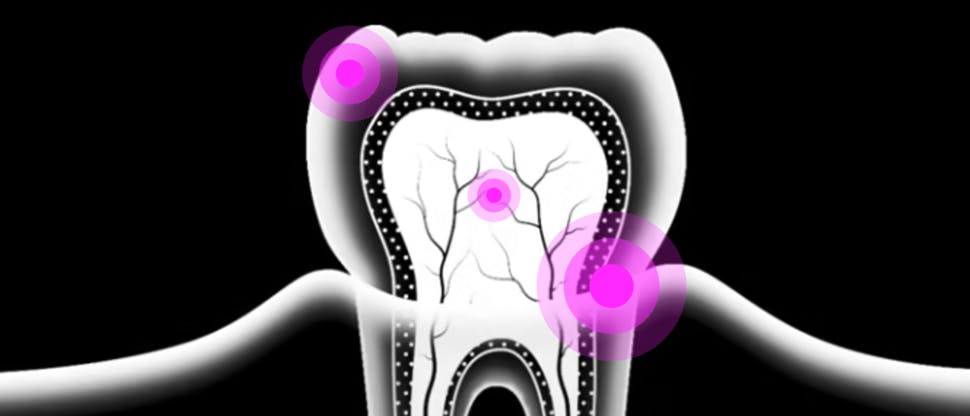 Image showing tooth x-ray with pink highlight on pain spots