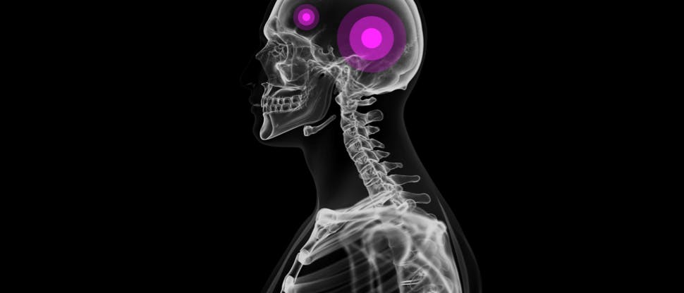 Image showing head x-ray with pink highlight on migraine pain spots