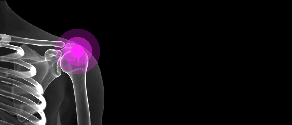 Image showing shoulder x-ray with pink highlight on pain spot