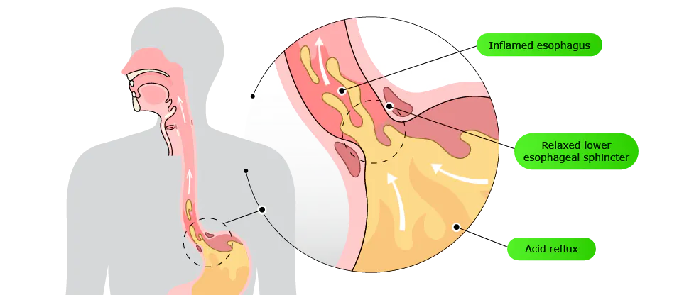 Diagram of the throat, esophagus, and stomach. A close‑up view shows stomach acid rising upward toward the esophagus.