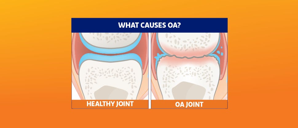 Healthy knee and OA knee comparison