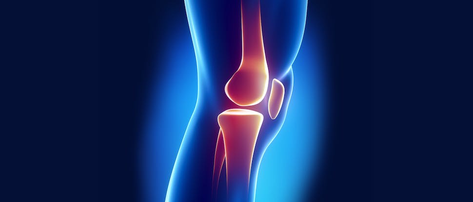 Illustration showing osteoarthritis of the knee