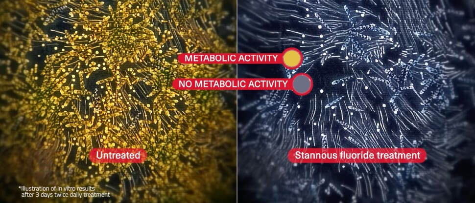 Image of S. mutans plaque bacteria to show efficacy of stannous fluoride in reduction of biofilm metabolic activity 
