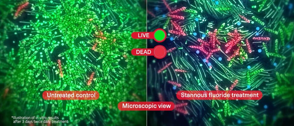 Image of S. mutans plaque bacteria to show efficacy of stannous fluoride in killing plaque bacteria 