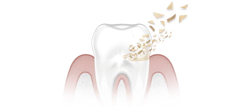 Stannous fluoride at work