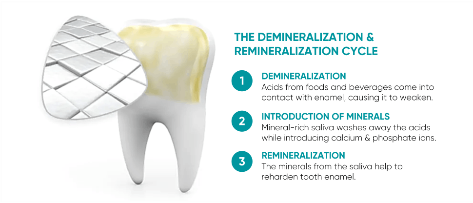 Demineralization and remineralization