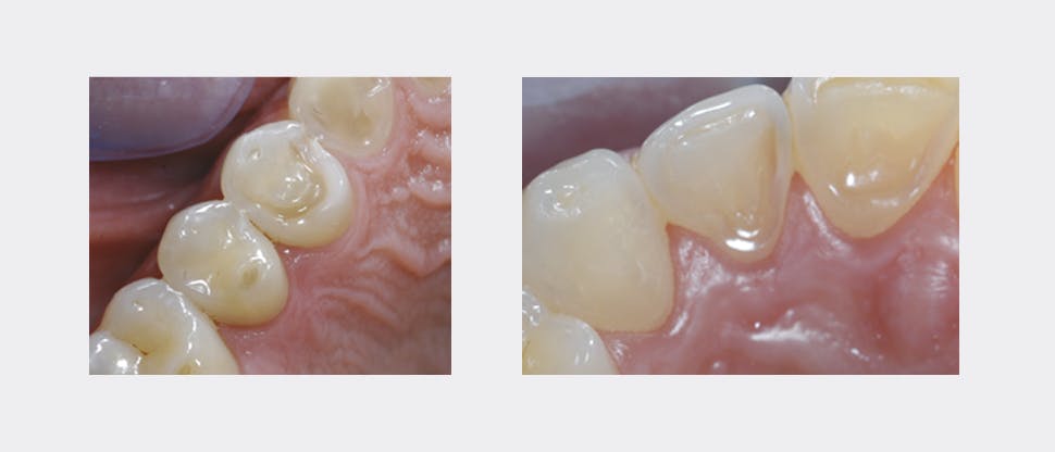 Other signs of enamel erosion