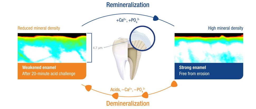 Remineralization and demineralization process after 20-minute acid challenge