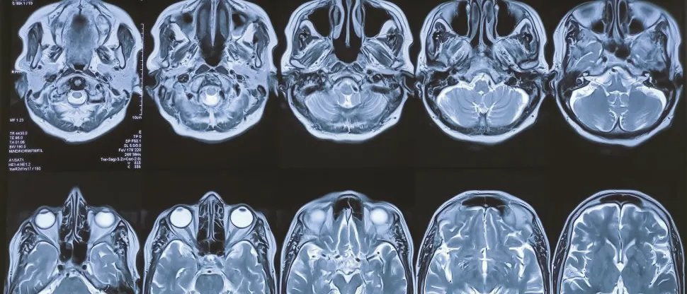Periodontal Disease and Cognitive Decline