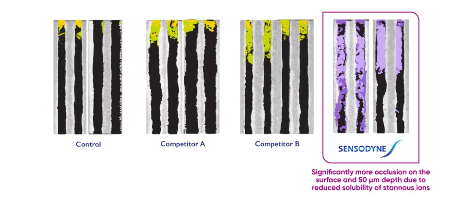 In vitro of tubules demonstrating stannous fluoride occlusion