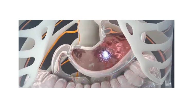Picture of a stomach