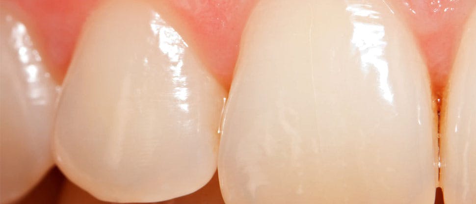 Enamel worn teeth