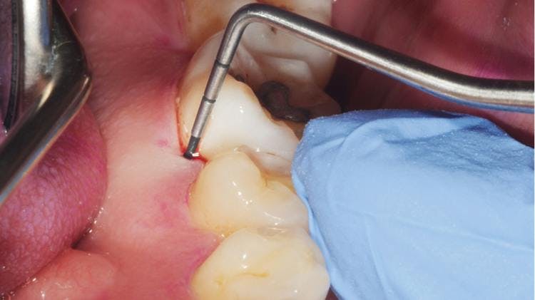 Patient with periodontitis and bleeding gum