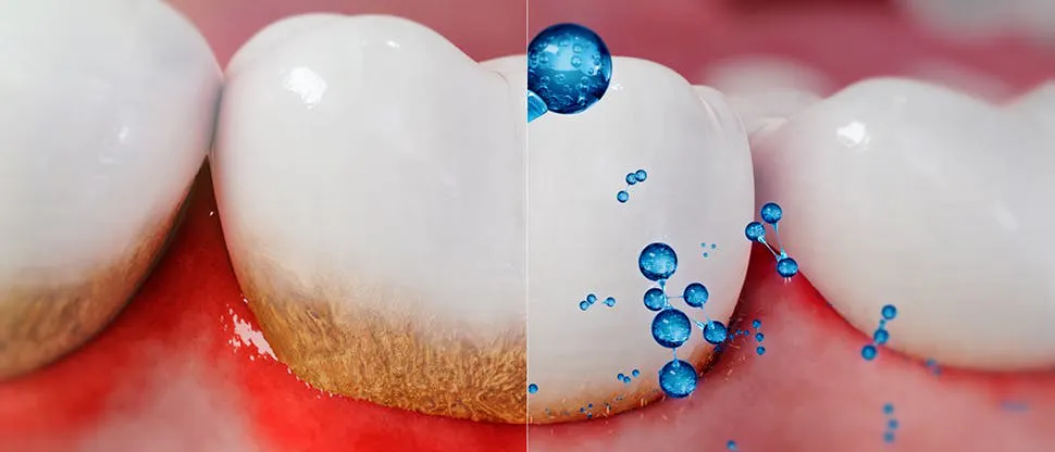 Driving updated insight into the disruptive action of sodium bicarbonate 