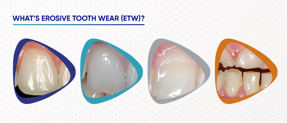 Image showing teeth with erosive tooth wear