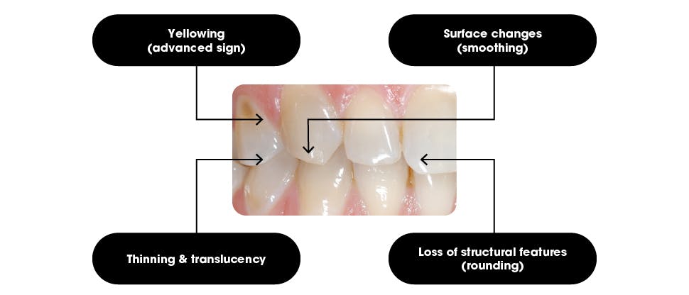 Diagram of teeth with enamel erosion. Signs include yellowing teeth, smooth enamel, rounded edges, enamel thinning