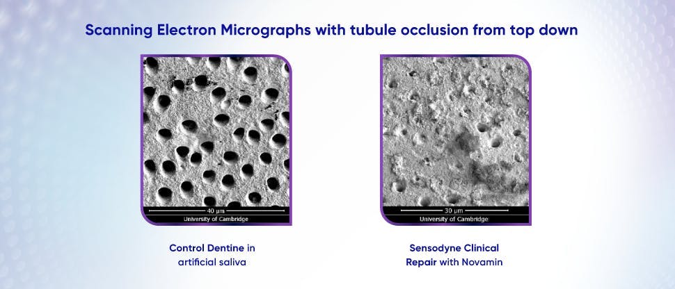 Image of dentine tubules after treatment with toothpaste