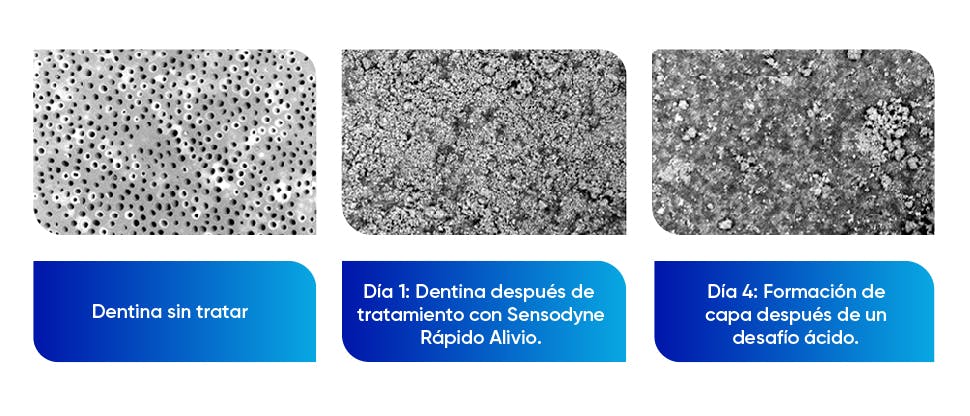 Imágenes de cerca de la dentina antes y después del tratamiento con fluoruro de estaño