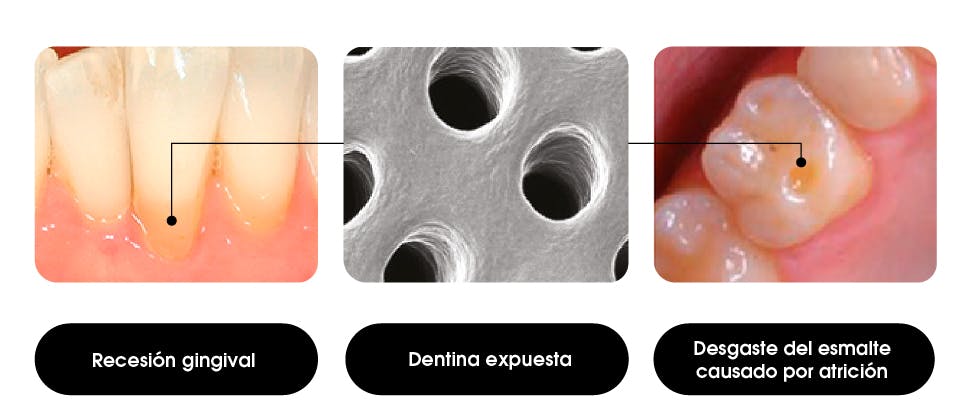 Causas de la dentina expuesta